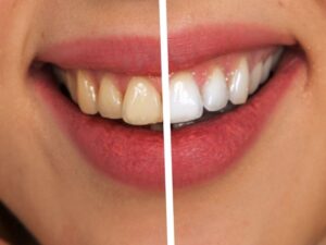 Teeth Whitening