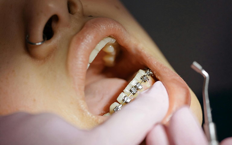 Traditional metal dental braces