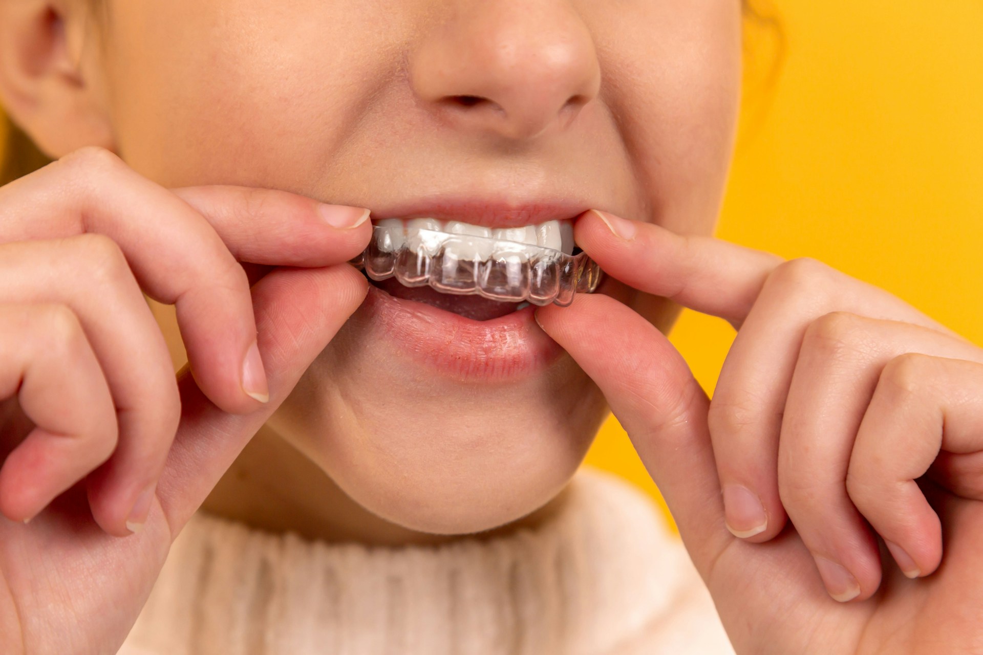 Close-up of a patient wearing clear Invisalign aligners for teeth straightening
