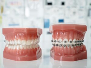 Dental models comparing traditional braces vs Invisalign aligners