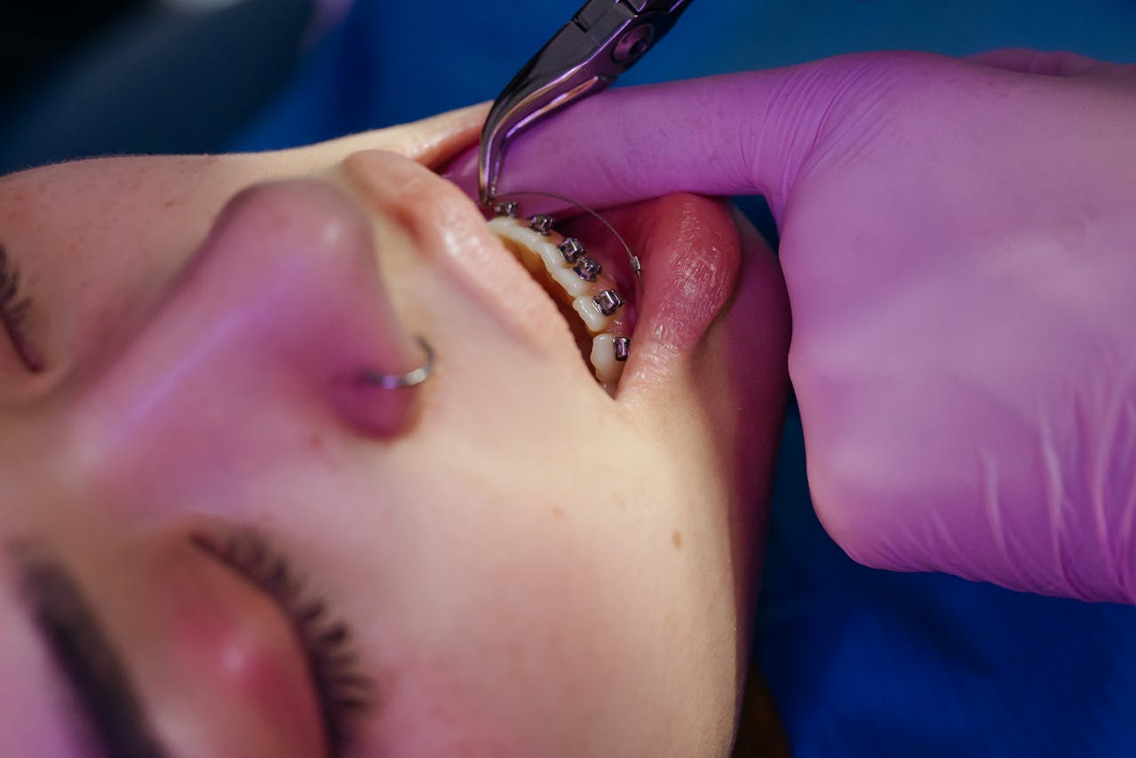 Orthodontist adjusting traditional braces during dental treatment