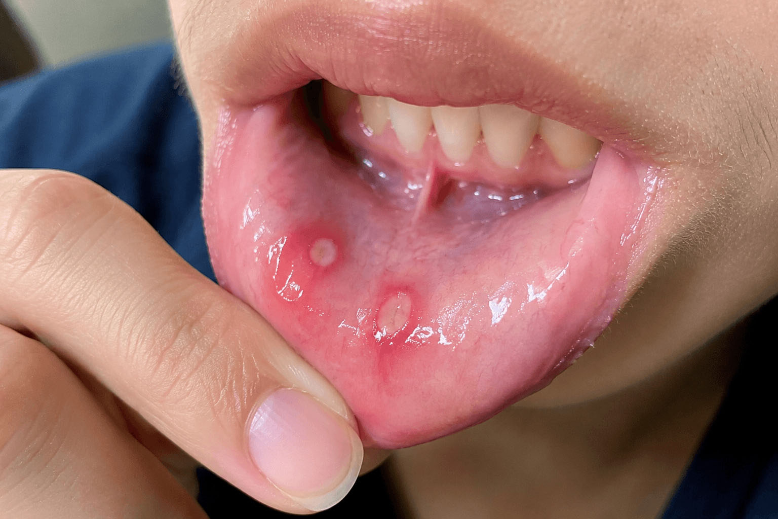 Canker sores on inner lip with white ulcers and red borders
