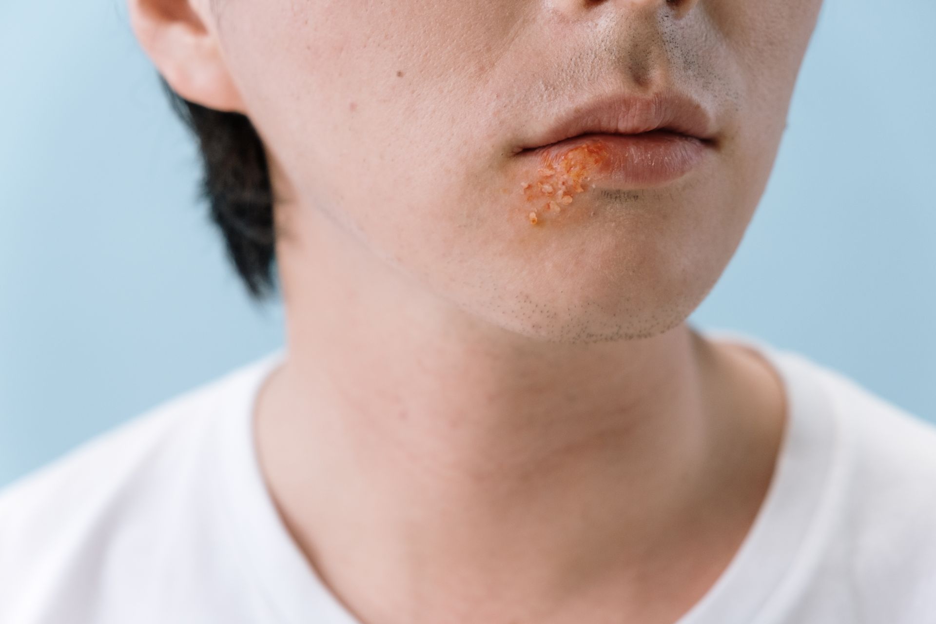 Cold sore blister outbreak on lower lip caused by HSV-1 virus